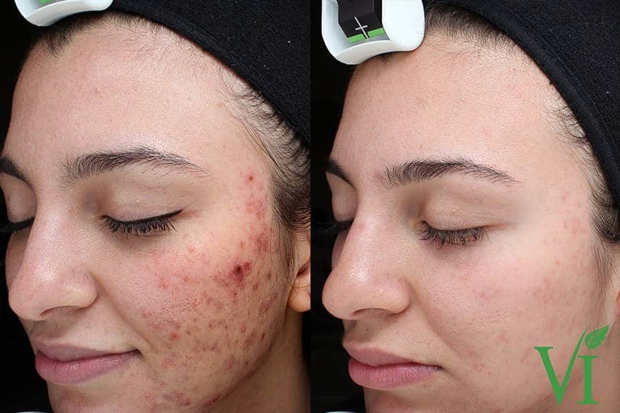 The VI peel will help to improve the tone, texture, and clarity of your skin while also providing anti-aging benefits. Not only is the peel ideal for anti-aging, it can safely and effectively treat acne and acne scarring, hyperpigmentation, and even melasma. It is a medium-depth peel that is safe for all skin types.